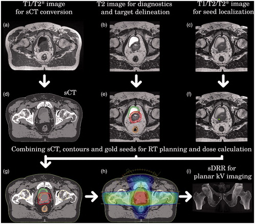 Figure 1. MRI-only based RT planning workflow. (a) Presents T1/T2*-weighted in-phase image used for sCT and (d) construction. (b) Illustrates T2-weighted image applied for target delineation (e). Part (c) shows the T1/T2/T2*-weighted image adopted for gold marker verification (f). Part (g) presents the final sCT used for dose calculation (h) and IGRT with CBCT localization. Part (i) shows AP substitute DRR generated from the sCT in case IGRT is based on planar localization.