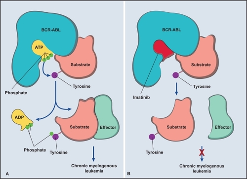 Figure 1 Mechanism of action of imatinib. A) The phosphorylation and activation of tyrosine residue after binding of adenosine triphosphate ATP in the kinase domain on the BCR-ABL oncoprotein. B) Prevention of phosphorylation and activation of tyrosine residue when imatinib binds to the kinase domain. Adapted with permission from Savage DG, Antman KH. Imatinib mesylate – a new oral targeted therapy. N Engl J Med. 2002;346:683–693.Citation41 Copyright © 2002 Massuchusetts Medical Society. All rights reserved.