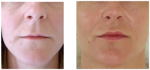 Figure 3 Before (A) and after (B) example of soft tissue augmentation of the lips with the Fulfil implant at 12 months.