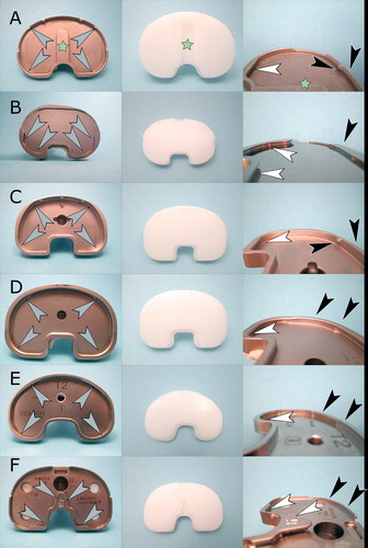 Figure 1. Locking mechanisms and inlays examined in this study. A. Triathlon knee: peripheral locking mechanism (gray arrows) with tongue and groove (white arrows) lock and a mechanism incorporating retaining wire held by metal barbs (black arrows). Asterisks indicate the anti-rotational central island. B. Genesis II knee with a dovetail locking mechanism (gray arrows) which incorporates a posterior dovetail (white arrows) and a small anterior wall (black arrows). C. Scorpio knee: peripheral locking mechanism (gray arrows) with tongue and groove (white arrows) lock and a mechanism incorporating retaining wire held by metal barbs (black arrows). D. PFC Sigma knee: peripheral locking mechanism (gray arrows) with anterior and posterior tongue and groove locks (white and black arrows). E. Search knee: peripheral locking mechanism (gray arrows) with anterior and posterior tongue and groove locks (white and black arrows). F. NexGen knee: dovetail locking mechanism (gray arrows) with central dovetail (white arrows) and small anterior wall (black arrows).