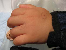 Fig. 1.  Two small bite wounds (circled with black pen) noted on the dorsal aspect of the left hand of a four year old boy.