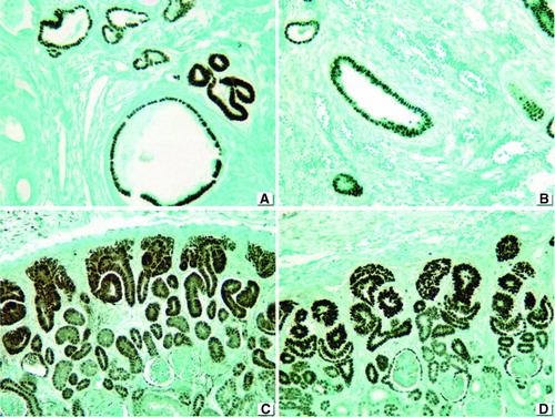 FIGURE 3  PAX2. (A) Positive staining in dysplastic tubular epithelium and proximal tubules in obstructive MCDK. (B) Nonobstructive MCDK, positive staining in dysplastic tubular epithelium and proximal tubules. (C) Strong staining in fetal kidney. (D) Overexpression of PAX2 in nephrogenic zone of immature kidney (less than 36 weeks). 76 × 57 mm.