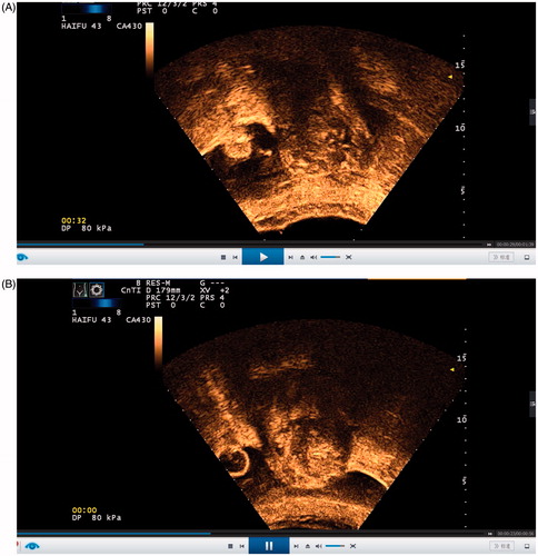 Figure B1–2. (B1) CEUS image before the HIFU procedure. (B2) CEUS image immediately after the HIFU procedure.