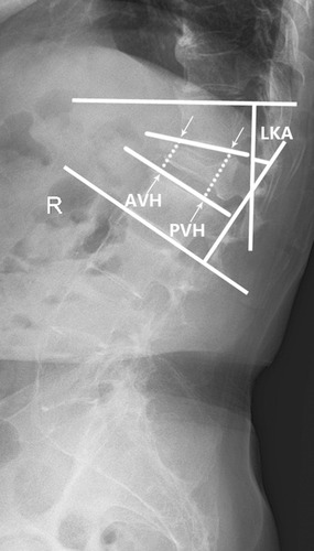 Figure 2 Measuring method of local kyphotic angle (LKA), anterior vertebral height (AVH), and posterior vertebral height (PVH).