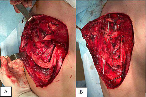 Figure 3 Intraoperative view. (A) View of right hemithorax after sketetalization of the deformed ribs; (B) Installed wire-frame construction.