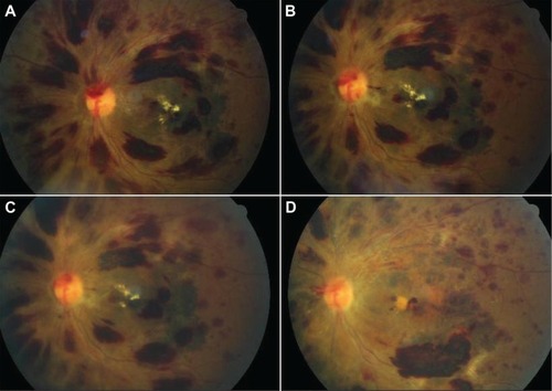 Figure 1 A 27-year-old patient with central retinal vein occlusion-like picture in both eyes. A: diffuse nerve fiber layer retinal hemorrhages with exudative macular edema. B: 40 days later with same findings. C: after 3 weeks, retinal hemorrhages have decreased in size. D: 6 months after last photograph (8 months after initial photograph), many retinal hemorrhages around macula have resolved.
