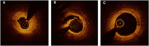 Figure 2 Representative optical coherence tomography (OCT) images of late lumen enlargement after drug-coated balloon (DCB) treatment for de-novo coronary artery lesions exceeding 2.5 mm in diameter. OCT images before the percutaneous coronary intervention procedure (A), immediately after the DCB was used (B), and at 7 months of follow-up (C).