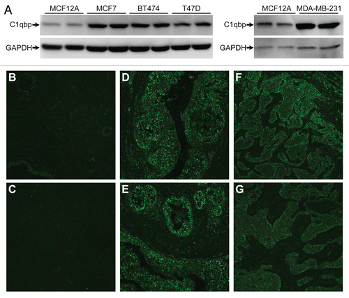 Figure 3 Mitochondrial C1qbp is upregulated in human breast cancer cells and tumors. (A) Protein gel blotting for C1qbp in the normal breast epithelial line MCF12A and in the MCF7, BT474, T47D and MDA-MB-231 breast cancer cell lines. GAPDH was used as a loading control. The results shown are representative of 3 and 4 independent experiments performed in duplicate. (B–G) Fluorescent immunohistochemical staining for C1qbp in sections from: (B and C) normal human breast tissue; (D and E) breast invasive ductal carcinoma and (F and G) breast mucous adenocarcinoma. Results are representative of staining from 4 different patient samples in each group.