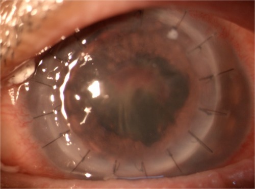 Figure 2 Biomicroscopic photograph of left eye after penetrating keratoplasty for corneal scar.