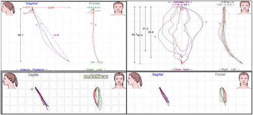 Figure 11. Jaw movements were recorded by the K7 computerized mandibular scanner at the 23-year follow-up. Mandibular movements were smooth (upper-left). Velocity of movements was not consistent, but was acceptable (upper-right). Jaw movements during gum chewing were recorded: left side chewing (bottom-left) and right side chewing (bottom-right).