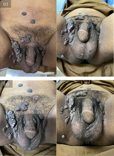 Figure 1 (a–d) Clinical manifestation before treatment (a); after first injection (b); second injection (c); and third injection (d).