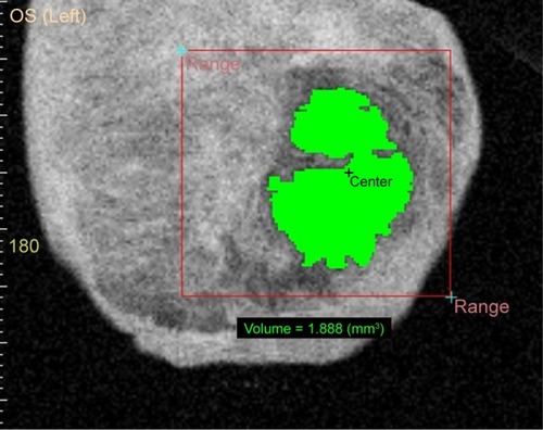 Figure 1 Example of the result of measuring the volume of bleb with CASIA. SS-1000; Tomey, Nagoya, Japan.
