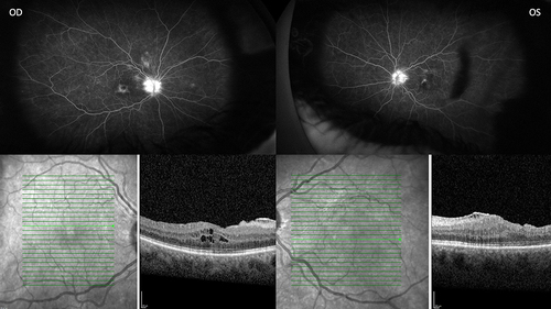 Figure 3 Improved macular edema 3 months after YUTIQ OD and 1 month after YUTIQ OS, widefield fluorescein angiography (Optos) and optical coherence tomography. Bright green line indicates section of image provided and green arrow has no significance.
