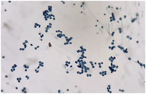 Figure 2. CSF study showed increased leukocytes of immature blast type with high N/C ratios and thick nuclear membrane in Pap stain.