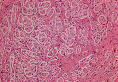 Figure 4.  The course of nerve fibers in conduit 6 months operatively (cross section) 20X.