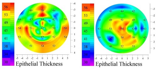 Figure 12 Examples of epithelium (patients subjected to CXL and partial topography guided PRK) demonstrating localized variations.
