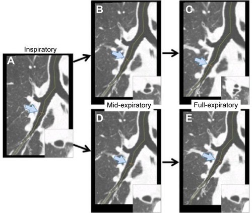 Figure 2 An example of curved multi-planar reconstruction images with and without anatomical synchronization.