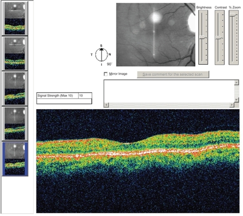 Figure 1b Optical coherence tomography image of a normal macula. The layers of the sensory retina appear homogeneous throughout, with a normal foveal depression.