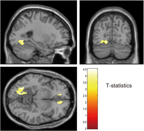 Figure 3 Voxel-based analysis showed that the patients with DAI exhibited 18F-FPYBF-2 uptake relative to controls in right superior frontal gyrus, left medial orbital gyrus and left occipital gyrus. p < 0.001 uncorrected for voxel level and p <0.05 FWE corrected for cluster level.