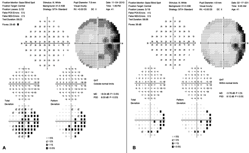 FIGURE 3  Humphrey visual field 30-2, right eye. Baseline visual field shows an enlarged blind spot and temporal depression (A). The visual field three months after treatment is improved (B).