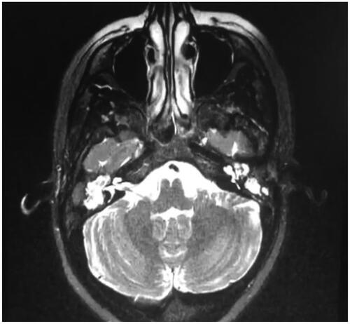 Figure 4. Magnetic resonance imaging in axial view, with areas of hyperintensity in the mastoids, in T2 sequence, axial view.