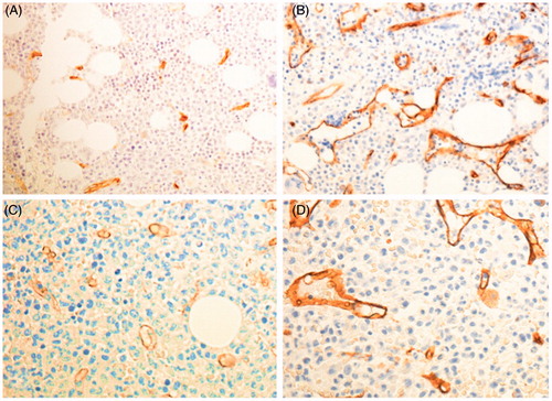 Figure 1. Increased sinusoidal dilatation after ruxolitinib treatment. Anti CD-34 immunohistochemical staining, 200× magnification. Patients 5 and 7 at baseline (a, c) and after 24 and 12 months of treatment, respectively (b, d). In these patients, fibrosis and cellularity remained stable [Table I].