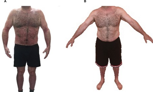 Figure 1 Picture of patient’s skin at baseline (A) and 3 months after IV delivery of SVF (B).