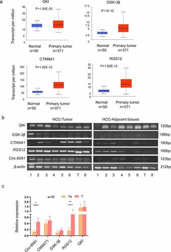 Figure 4. The elevated expression level of circ-0006091 target genes in HCC. (a) the histogram of QKI, CTNNA1, GSK-3b, and RGS12 was obtained through Ualcan, respectively. (b) The expression of the genes i.e., CTNNA1, QKI, GSK-3b, and RGS12 were evaluated via RT-PCR in HCC tumor tissues (n = 8) and matched normal tissues (n = 8). Each band means a different patient sample. (c) The expression of these genes (CTNNA1, QKI, GSK-3b, RGS12, and hsa_circ_0006091) were determined by q-PCR in HCC tumor tissues (n = 52), and matched normal tissues (n = 52).