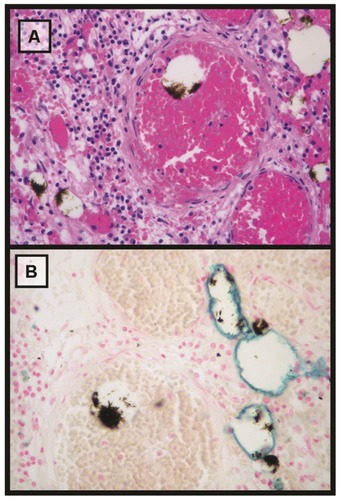 Figure 7 Microscopic analysis (25×) of tumor tissue stained with hematoxylin-eosin and Perls’ Prussian blue. (A) Hematoxylin-eosin stain. Scattered brown deposits of magnetic fluid within vascular structures can be observed. (B) Perls’ Prussian blue. The iron in the deposits of the magnetic fluids does not appear stained, probably due to the intense aggregation. Moreover, non-aggregated iron nanoparticles can be observed as a blue line over the inner edge of the vascular structures.