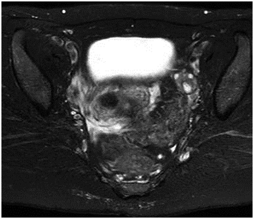 Figure 1. Pelvic MRI: On T2-weighted MRI, a low-intensity region with a clear boundary and a diameter of 20 mm protruding into the uterine cavity is seen. MRI, magnetic resonance imaging.