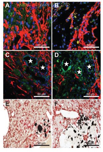 Figure 7 Immunostaining was performed with glial fibrillary acidic protein (astrocyte marker; red), and Ki67 (proliferation marker) in (A) the experimental control group (without subventricular zone neural progenitor cell transplantation) and (B) the subventricular zone neural progenitor cells alone, (C) hydrophilic carbon nanotubes impregnated with subventricular zone neural progenitor cell, and (D) hydrophobic carbon nanotubes impregnated with subventricular zone neural progenitor cell transplantation groups 5 weeks after middle cerebral artery occlusion injury. Glial fibrillary immunopositive cells are stained red and Ki67 immunopositive cells are stained green. The diaminobenzidine staining results for glial fibrillary acidic protein immunoreactivity (evidenced by brown-stained cells) in (E) hydrophilic and (F) hydrophobic carbon nanotubes impregnated with subventricular zone neural progenitor cells are also shown.Notes: Carbon nanotubes appear black in the histological sections and are marked by □. Original magnification for immunohistological staining was ×800. Bar =50 μm.Abbreviation: DAPI, 4′,6-diamidino-2-phenylindole.