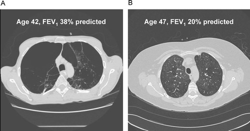 Figure 1 Computed tomography (CT) scans from two participants in the Boston Early-Onset COPD Study, demonstrating the disconnect between emphysema severity on CT scans and lung function testing in patients with COPD. Subject A has severe emphysema yet higher lung function (emphysema severity score = 21.7; FEV1 = 38% predicted) than Subject B, who has minimal emphysema and lower lung function (emphysema severity score = 4.0; FEV1 = 20% predicted). The mosaic attenuation in Subject B is consistent with airways disease as a cause for the severe airflow obstruction.