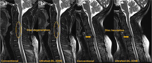 Figure 3 Sagittal T2-weighted images of a participant with disc degeneration (C3-4, C4-5 and C5-6 discs, Orange ellipses), were obtained from both conventional (a) and ultrafast-DL-3DIIE (b) protocols. And sagittal T2-weighted images of a participant with disc herniation (C5-6 disc, Orange arrows), obtained from both conventional (c) and ultrafast-DL-3DIIE (d) protocols.