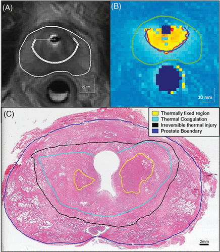 Figure 8. Results of preliminary human evaluation of MRI-controlled transurethral ultraosund therapy. (A) T2-weighted axial image shows the prostate boundary, and boundary of the target region selected for treatment. (B) The maximum temperature map acquired after treatment depicts successful heating of the target boundary to the desired critical temperature of 55°C. (C) An H&E stained whole-mount section in the prostate gland obtained in the plane of treatment depicts a continuous pattern of thermal damage, with a well-demarcated boundary of thermal coagulation. The transition to the outer boundary of irreversible thermal injury is ≤2 mm, consistent with the findings in canine prostate.