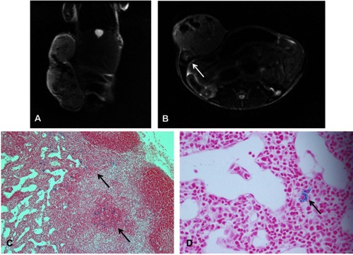 Figure 5 MRI and iron staining of an inguinal lymph node 35 days after injection of iron-labeled SGC-7901 cells in nude mice. (A) Coronal T2-weighted images of the primary tumor. (B) Axial T2-weighted image of the same mouse reveals a region of signal loss in the ipsilateral inguinal node (arrow). (C) Section of lymph node stained with PPB for iron detection at ×10 magnification shows iron-positive cells in the area of the node corresponding to the region signal loss in the MR image (arrow). (D) Iron-positive area of the node at ×40 magnification, where the MPIO beads can be seen (arrow), suggesting that the SGC-7901 cells have retained iron particles after migrating to the node.