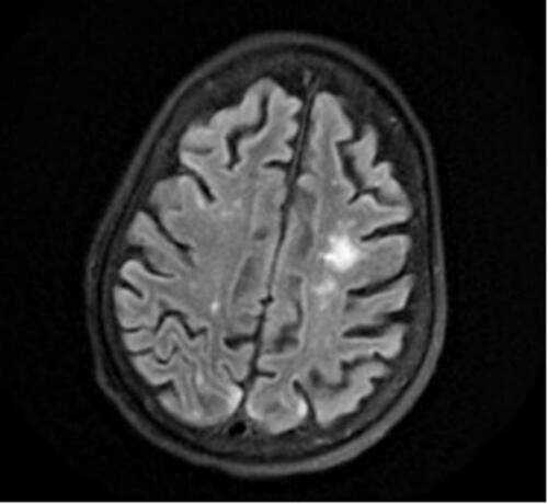 Figure 2 Brain MRI showing new areas representing subacute watershed infarctions with several punctate areas of acute infarction within the bilateral anterior cerebral artery/middle cerebral artery watershed territories.