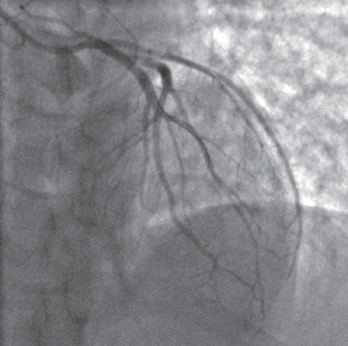 Figure 4. Final result after stent deployment in the LAD.