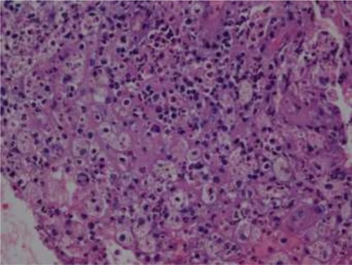 Figure 6 Some of infiltrating histiocytes show hemophagocytic activity characterized by intracytoplasmic nuclear debris (hematoxylin-eosin; original magnification: ×400).