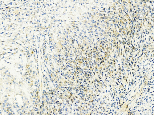 Figure S3 DLL4+ tumor cells in case 36.