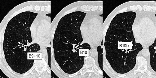 Figure 4 High resolution native MDCT images reconstructed using a 7682 matrix (voxel size: 0.4 mm per side) in a patient with COPD. Images are zoomed on the right lung base (B9, B10, B10bc, according to the Boyden classification).