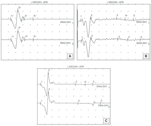 Figure 3. The waveform of normal gastrocnemius compound action potential (A); the waveform of gastrocnemius compound action potential in the experimental group (B); the waveform of gastrocnemius compound action potential in the control group (C).