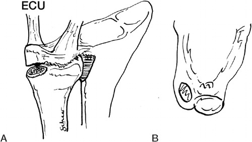 Figure 6. Fracture through the base of the ulnar styloid (type 2). A. Oblique palmar view. The TFCC was displaced together with the ulnar styloid fragment. B. Transverse view. Note the absence of dorsal separation between the ECU tendon sheath and the TFCC.