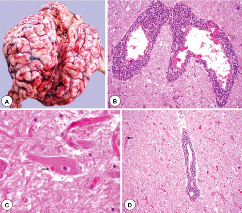 Figure 1. Gross and histopathological lesions in rabies. (A) Marked congestion of blood vessels in sulci of swollen cerebral hemispheres. (B) Massive perivascular infiltration with mononuclear cells (lymphocytes and macrophages) around dilated blood vessels in white matter of camel brain. H&E x400. (C) Dense eosinophilic and sharply outlined Negri bodies (arrow) of various sizes in the cytoplasm of intact neuron in camel brainstem section. H&E x400. (D) Brain section showing degenerated neurons, severe cuffing with mononuclear cells and edema. A Negri body is also visible in the degenerated neuron (arrow) having mild diffuse gliosis. H&E x200.