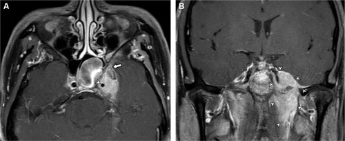 Figure 4 Magnetic resonance imaging of the brain, orbit, and neck.