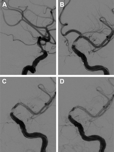 Figure 4 Head DSA images showing acute in-stent thrombosis and treatment with arterial thrombolysis.