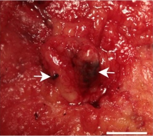 Figure 3 A photograph demonstrating the black-dyed lymph nodes (shown by the white arrows) in breast tissue 1 day postinjection of nanoparticle carbon suspension.Notes: Scale bar is 1 cm. Reprinted from Diagn Microbiol Infect Dis, 67(2), Tang JF, Xu ZH, Zhou L, Qin H, Wang YF, Wang HH, Rapid and simultaneous detection of Ureaplasma parvum and Chlamydia tra chomatis antibodies based on visual protein microarray using gold nanoparticles and silver enhancement, 122–128, Copyright (2010), with permission from Elsevier.Citation104