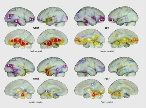 Figure 1. A summary of human brain arousals and inhibitions in humans experiencing four basic emotions (from autobiographical memory): Sadness (PANIC/GRIEF), Happiness (PLAY/JOY), anger (RAGE) and anxiety (FEAR) during positron emissions tomography (PET) scanning. Data are summarized in finer detail by Damasio et al.Citation25 Distinct subcortical brain regions exhibit abundant arousals (reds and yellows) during each of these emotions, while there are abundant cortical inhibitions (reduced blood flow, coded as blues and purples) present in many cortical areas. To facilitate reading, upward arrows indicate increased brain arousals and downward arrows indicate reduced brain regional arousals. (The statistical “coarse kernel” data from Damasio et alCitation25 were kindly provided by Antonio Damasio).