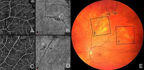 Figure 6 Optical coherence tomography angiography in lattice degeneration. (A) Optical coherence tomography angiography projection of full retina slab showing retinal capillary nonperfusion (asterisk) within the lesion. (B) Optical coherence tomography angiography projection of choriocapillaris slab showing choriocapillaris rarefication within the lesion (number sign). (C) Optical coherence tomography angiography projection of full retina slab showing retinal capillary nonperfusion (asterisk) within the lesion. (D) Optical coherence tomography angiography projection of choriocapillaris slab showing choriocapillaris rarefication within the lesion (number sign). (E) Wide-field color fundus photography showing lesions captured with optical coherence tomography angiography. Black box 1 shows position of the scan in (A and B). Black box 2 shows position of the scan in (C and D).