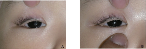 Figure 2 A) The same 3-year-old girl. Spine position during general anesthesia without downward traction of the skin. The eyelashes are directed toward the cornea. More redundant skin is observed in the lower eyelid than in the upright position (Figure 1A) and seems to have more influence of eyelash direction. B) Spine position during general anesthesia with downward traction of the skin. The direction of the eyelashes has not changed significantly compared with the upright position (Figure 1B).