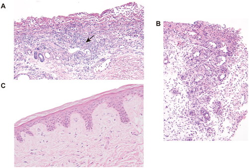 Figure 3. H&E staining of skin biopsy from the calciphylaxis patient before and during hAMSC treatment. (A) Specimen of biopsy obtained from the margin of an ulcer on the thigh, presented exfoliation of epidermis, necrosis, and extensive inflammatory cells infiltration around microvessels (black arrow) before hAMSC treatment (200×). (B) After hAMSC treatment for 1month, skin biopsy showed regenerative tissue with reduced inflammation and absence of epidermis (200×). (C) Intact epidermis, well-aligned collagen without visible inflammatory reaction after hAMSC treatment for 20 months (400×). H&E: Hematoxylin and eosin; hAMSC: human amnion-derived mesenchymal stem cell.
